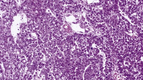 FIG. 16.9, Embryonal carcinoma. Primitive-appearing cell population forming irregular tubular structures (pseudoglandular pattern).