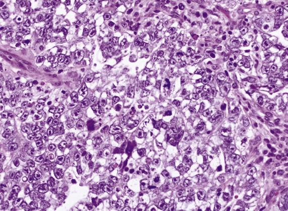 FIG. 16.10, Embryonal carcinoma. Tumor cells are highly pleomorphic with large, vesicular, and irregularly shaped nuclei, prominent nucleoli, and conspicuous mitoses.