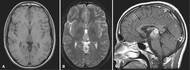 Fig. 18.1, Pineal germinoma. A pineal region germinoma in a 16-year-old male demonstrates hypointense T1 (A) and isointense T2 (B) magnetic resonance imaging (MRI) signals. Heterogeneous contrast enhancement is noted on a postcontrast sagittal sequence (C). Note the local invasion of the tectum of midbrain by pineal germinoma.