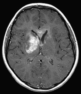 Fig. 18.3, Basal ganglia germinoma. A heterogeneously enhancing infiltrating mass with multiple cystic components is present in the right basal ganglia, corpus callosum, left caudate, right centrum semiovale, corona radiata, and right medial temporal lobe on post-contrast MRI. There is mass effect on the adjacent ventricles.