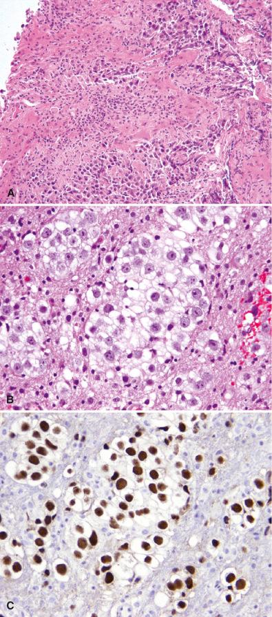 Fig. 18.6, Germinoma infiltrating brain parenchyma. (A, B) Germinomas are capable of parenchymal infiltration, making them difficult to distinguish from high-grade gliomas and metastatic carcinomas, especially in the presence of crush artifact. Note the intense astrocytic gliosis (A). (C) OCT4 immunohistochemistry is particularly useful in highlighting individual tumor cells of infiltrative germinomas.