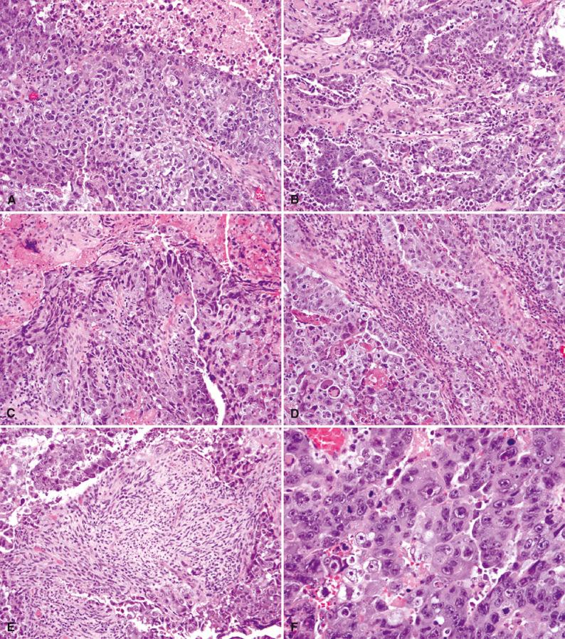 Fig. 18.8, Embryonal carcinoma. (A) Solid cohesive sheets of pleomorphic epithelial cells characterize this embryonal carcinoma. Note the mitoses and necrosis. (B) Glandular pattern. (C) The smudged embryonal carcinoma cells at the periphery are fairly frequent findings that show superficial resemblance to the “biphasic” pattern of choriocarcinoma. This phenomenon is often referred to as the “appliqué pattern.” (D) The presence of fibrous septae sprinkled with lymphocytes is less frequent in embryonal carcinoma than in germinoma. (E) Cellular neoplastic stroma within embryonal carcinoma likely constitutes a teratomatous element. (F) The cells of embryonal carcinoma are large and polygonal, with dark eosinophilic cytoplasm, large round-to-oval nuclei, and prominent nucleoli. (G) Mitoses are usually abundant. (H) The focal finding of syncytiotrophoblasts is not uncommon in embryonal carcinoma.