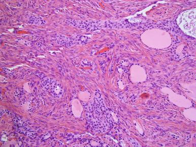 Fig. 26.12, Struma ovarii with uniformly distributed fascicles of fibrous stroma, mimicking an adenofibroma or Brenner tumor.