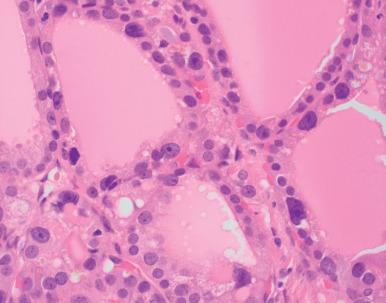 Fig. 26.13, Focal cytologic atypia in a benign struma ovarii.