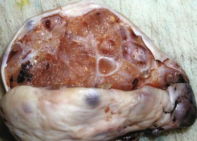 Fig. 26.15, Malignant struma ovarii, presenting as a solid mass-forming lesion expanding the ovarian capsule.