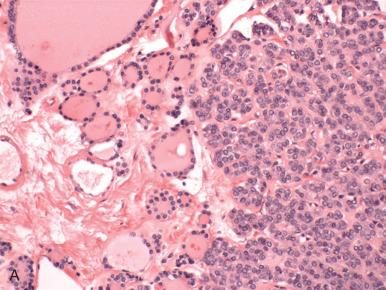 Fig. 26.17, Follicular variant of papillary thyroid-type carcinoma (malignant struma). A, Neoplastic acini (right) merge with normal thyroid tissue (left). B, At higher magnification, the classic nuclear features are visible, including nuclear pseudoinclusions, irregular nuclear membranes, and occasional nuclear grooves. Staining for HBME-1 (C) and CK19 (D) distinguish the neoplastic and benign thyroid tissue in this case.