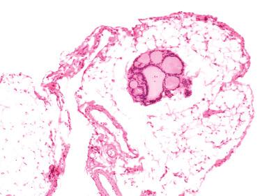 Fig. 26.18, Highly differentiated follicular carcinoma of ovarian derivation, seen here as small microscopic foci of innocuous-looking thyroid tissue in the omentum.