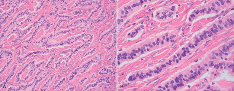 Fig. 26.21, Primary ovarian trabecular carcinoid. A, Forming linear cords and wavy ribbons. B, Nuclei are perpendicular to the cord axis.
