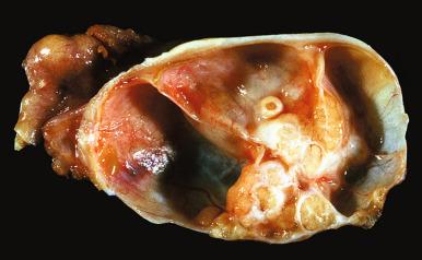 Fig. 26.3, Mature teratoma. The cyst contains a condensed mass from which the skin and appendages arise (Rokitansky tubercle).