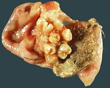 Fig. 26.4, Teeth and a portion of jaw in a mature teratoma.