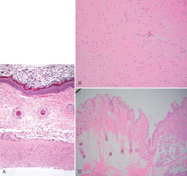 Fig. 26.6, Mature teratoma. A, Skin (above) and cerebral cortex (below). B, Glial tissue. C, Cutaneous adnexa of Rokitansky tubercle. D, Respiratory epithelium and underlying cartilage. E, Bone. F, Columnar epithelium over smooth muscle (viscus).