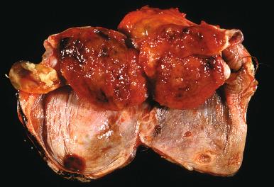 Fig. 26.10, Struma ovarii. This is the classic gross appearance of thyroid tissue forming a solid nodule in a cyst.