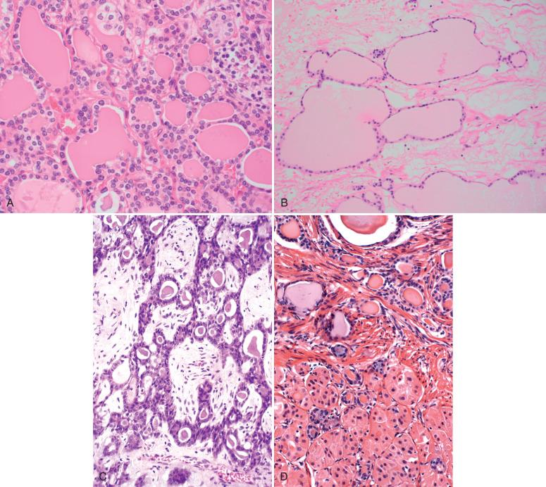 Fig. 26.11, Struma ovarii. A, Typical appearance of struma ovarii with variably sized follicles containing colloid. B, Cystic and attenuated follicles. C, Variable lumen formation, including interconnecting cords of epithelium. D, Hurthle cells in struma.