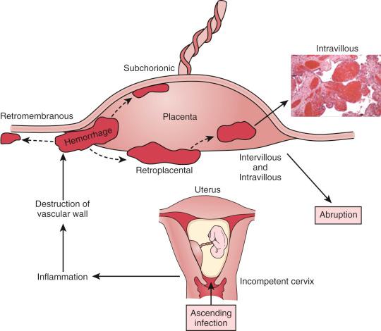 Fig. 33.1, Schematic evolution of inflammatory abruption, resulting from inflammation-induced disruption of maternal vessels, a consequence of ascending infection.