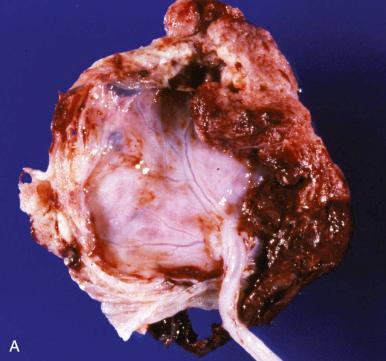 Fig. 33.2, Gross and microscopic features of inflammatory abruption in preterm delivery. A, Opaque fetal surface and adherent marginal hemorrhage. B, Impressive adherent marginal/retroplacental bleeding and detached clotted blood. C, Extensive intervillous hemorrhage splaying apart immature chorionic villi.