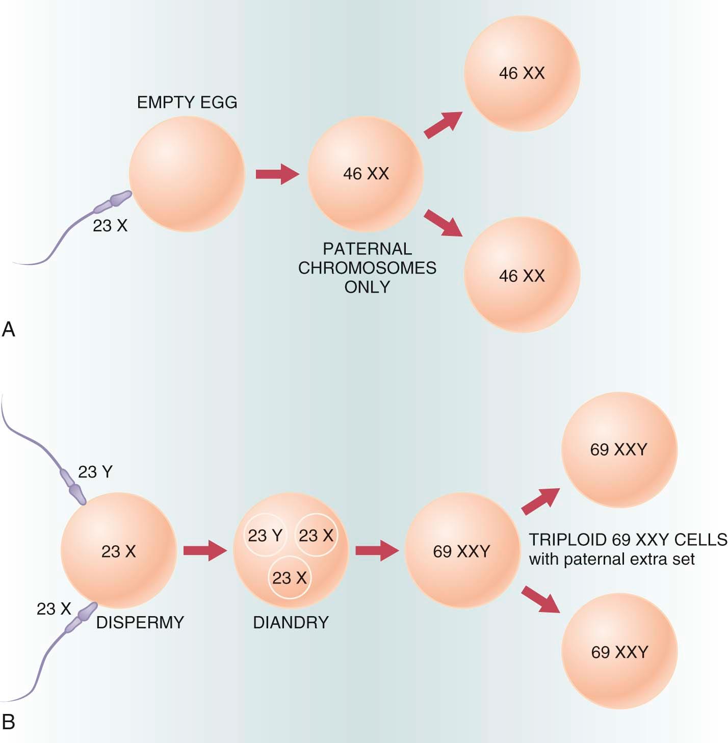 FIGURE 42-1, Cytogenetic makeup of hydatidiform mole. A, Chromosomal origin of a complete mole. A single sperm fertilizes an “empty egg.” Reduplication of its 23 X set gives a completely homozygous diploid genome of 46,XX. A similar result follows fertilization of an empty egg by two sperms with two independently drawn sets of 23 X or 23 Y; note that both karyotypes, 46,XX and 46,XY, can ensue. B, Chromosomal origin of the triploid, partial mole. A normal egg with a 23 X haploid set is fertilized by two sperms that can carry either sex chromosome to give a total of 69 chromosomes with a sex chromosome configuration of XXY, XXX, or XYY. A similar result can be obtained by fertilization with a sperm carrying the unreduced paternal genome 46,XY (resulting sex complement, XXY only).