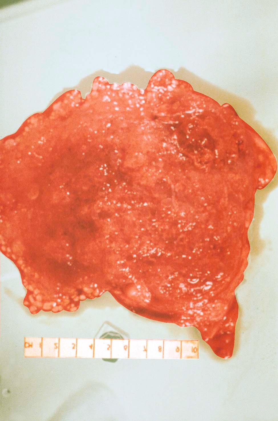 FIGURE 42-2, Complete hydatidiform mole. Multiple hydropic villi (vesicles), resembling a “bunch of grapes,” are admixed with areas of necrosis (white areas) and hemorrhage. Note the absence of a fetus.