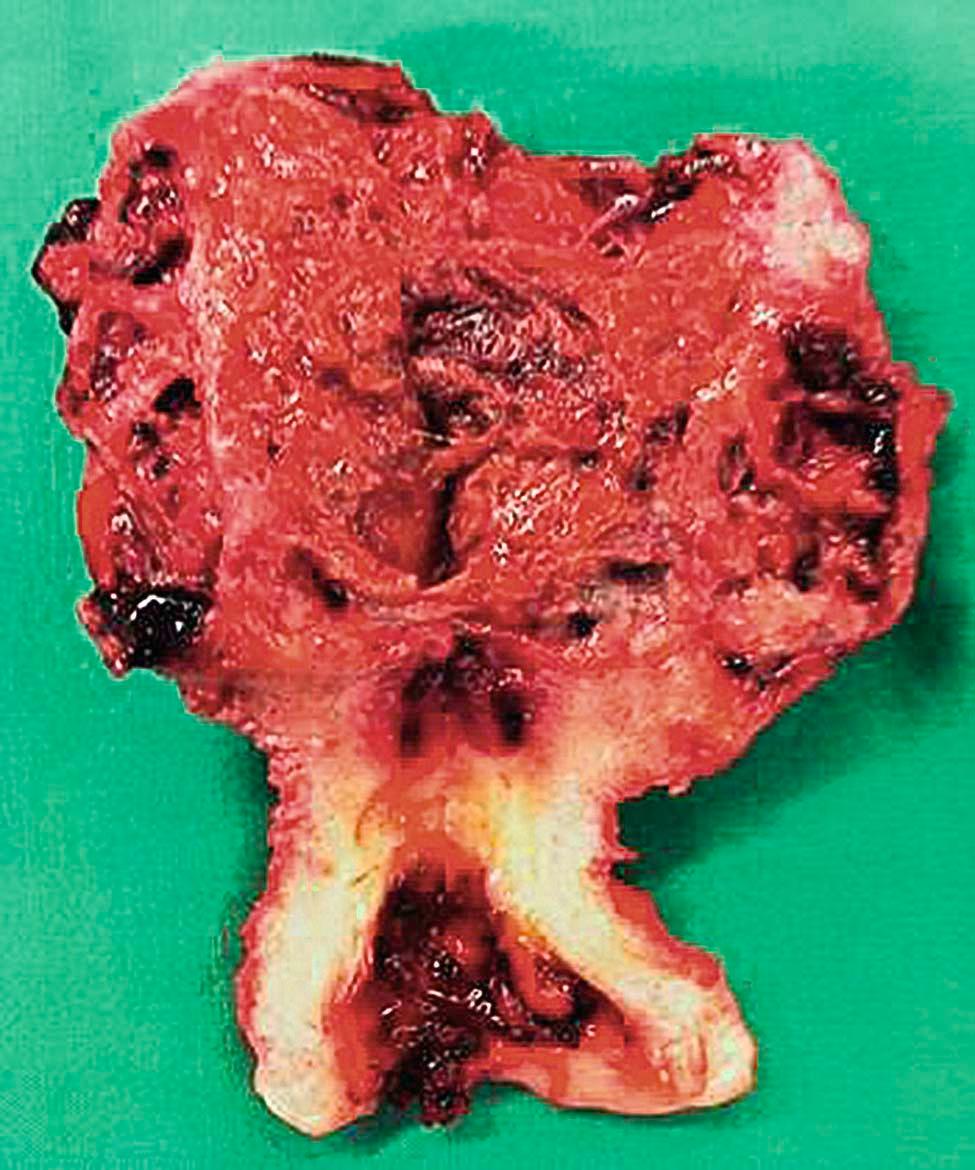 FIGURE 42-4, Uterine choriocarcinoma that has penetrated the serosa. The patient presented with a hemoperitoneum.