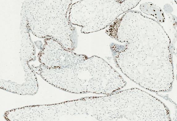 Fig. 19.11, Placental mesenchymal dysplasia. Some cases show a peculiar p57 staining pattern with retained expression in cytotrophoblast and lost expression in villous stromal cells.