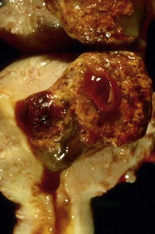 Fig. 19.2, Invasive hydatidiform mole. Chorionic villi extensively infiltrate the myometrium with a pushing border.