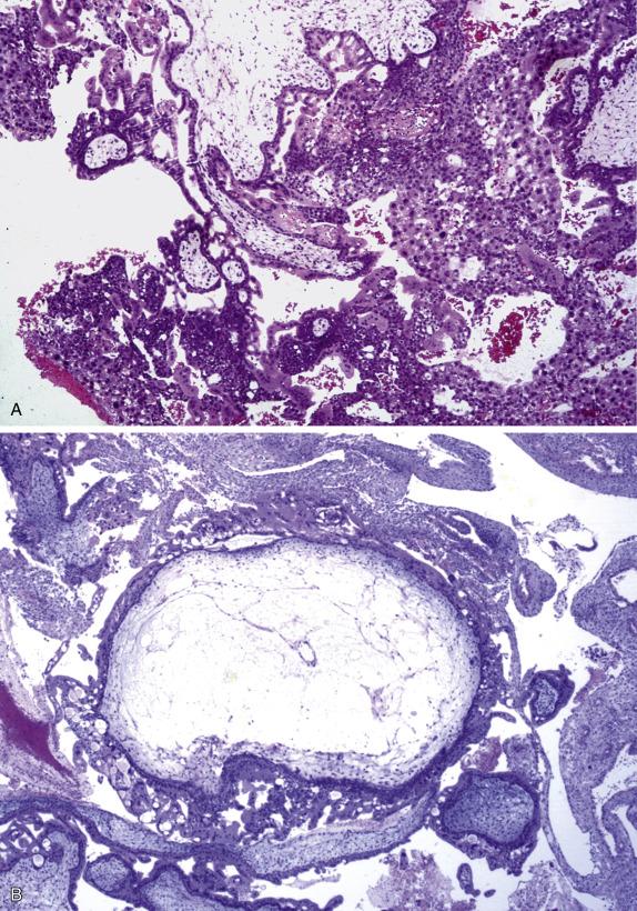 Fig. 19.3, Complete hydatidiform mole versus a normal gestation. Complete hydatidiform mole is characterized by enlarged hydropic chorionic villi surrounded by exuberant circumferential cyto- and syncytiotrophoblast proliferation (A). Villous edema is often associated with cistern formation; notice the prominent concentric villous trophoblast (B). In contrast, immature normal chorionic villi have a polar distribution of the proliferating cyto- and syncytiotrophoblast (C).