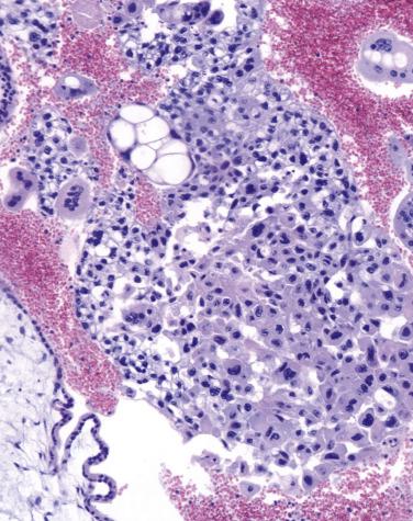 Fig. 19.4, Complete hydatidiform mole. The hyperplastic extravillous trophoblast shows striking cytologic atypia.