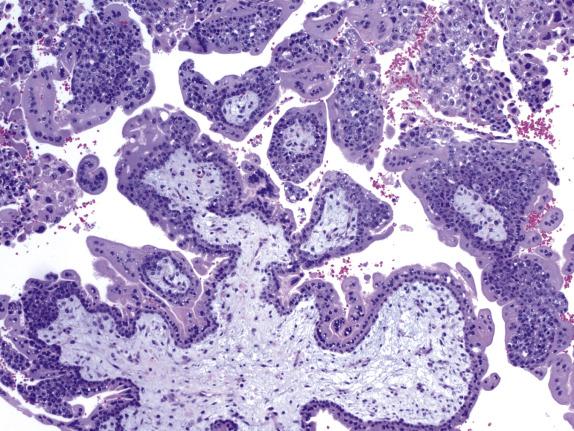 Fig. 19.5, Early complete hydatidiform mole. Mildly hydropic villi show only slight trophoblastic hyperplasia. Note the myxoid stroma, absence of patent capillaries and the “club-like” outline of the villi.