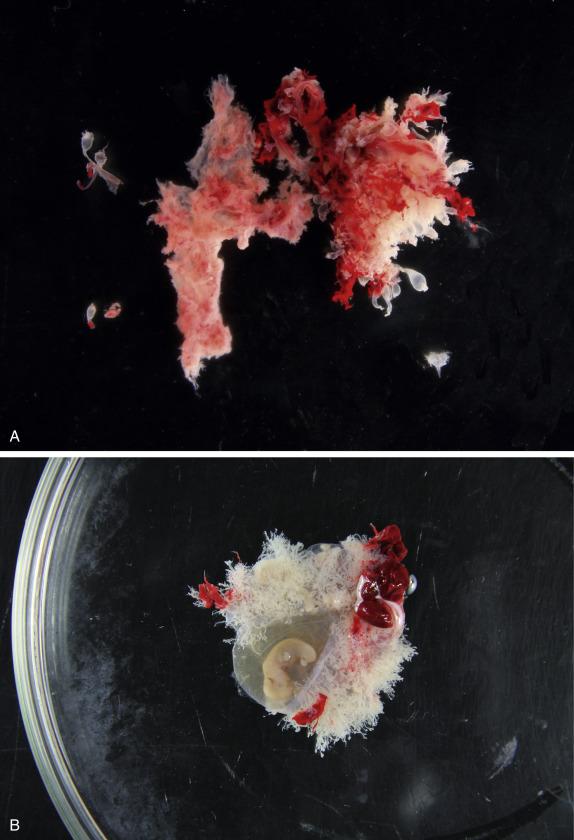 Fig. 19.6, Partial hydatidiform mole versus a normal gestation. In a partial hydatidiform mole there is more abundant tissue obtained from a curettage when compared to a missed abortion but less than that from a complete hydatidiform mole. Some chorionic villi have normal size and shape, which contrast with other villi that appear enlarged and edematous, some of them forming vesicles. (A). Compare to products of a normal gestation showing an intact sac, well-developed fetal tissue, and delicate slender chorionic villi (B).