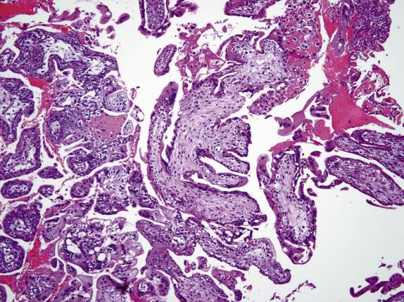 Fig. 19.7, Partial hydatidiform mole. Two populations of immature chorionic villi are noted; small with polarized trophoblast cells and enlarged with irregular convoluted outlines. Fibrosis of the villous stroma and modest “lacy” proliferation of syncytiotrophoblast is seen.