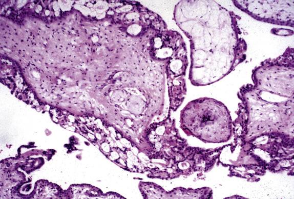 Fig. 19.8, Partial hydatidiform mole. Enlarged villi are surrounded by a “lacy” proliferation of syncytiotrophoblast. Note the irregular outline of some villi (bottom).