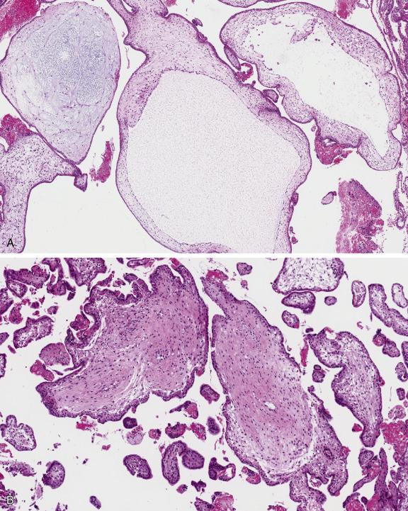 Fig. 19.10, Placental mesenchymal dysplasia. Markedly enlarged edematous villi with cistern formation (A) and fibromuscular hypertrophy (B); notice the absence of trophoblastic hyperplasia.