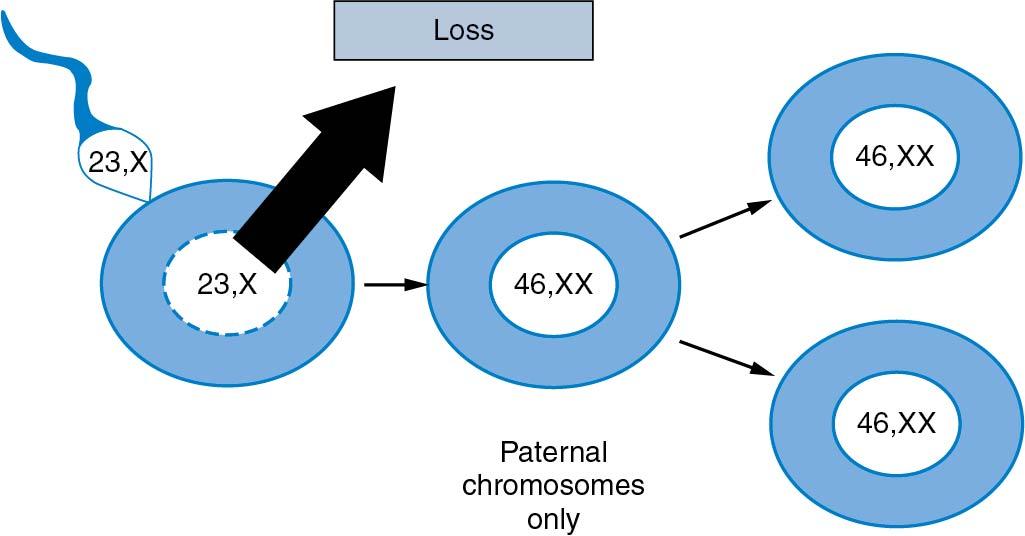 Fig. 34.1, Paternal chromosomal origin of a complete classic mode (46,XX). Left to right: Entry of normal sperm with haploid set of 23,X into an egg whose 23,X haploid set is lost. The egg is taken over by paternal chromosomes, which duplicate (without cell division) to reach the requisite complement of 46. Observe that almost the same result can be obtained through fertilization by two sperm gaining entry into an empty egg (dispermy).