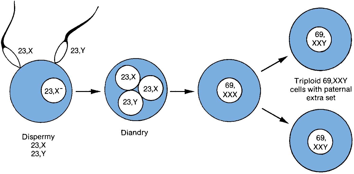 Fig. 34.2, Triploid chromosomal origin of partial mole (69,XXY dispermy). Fertilization of an egg equipped with a normal 23,X complement by two independently produced sperm (dispermy) to give a total of 69 chromosomes. Observe that triploidy can also result through fertilization by sperm carrying father’s total complement of 46,XY.