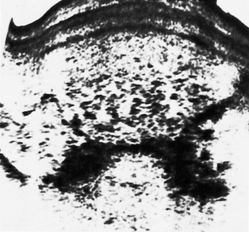 Fig. 34.4, Ultrasound scan of uterus demonstrating snowstorm appearance of hydatidiform mole.