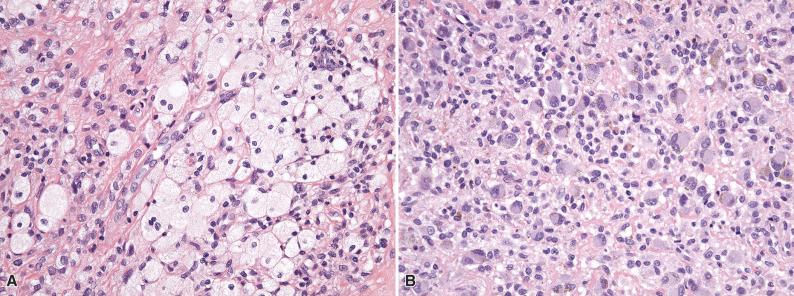 Figure 11.4, Giant Cell Tumor of Tendon Sheath.