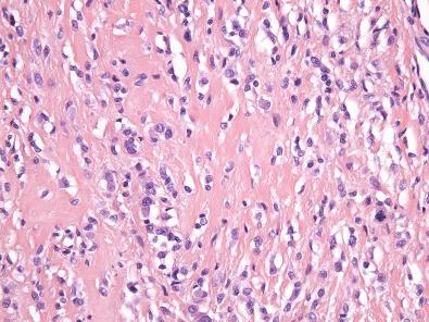 Figure 11.5, Giant Cell Tumor of Tendon Sheath.