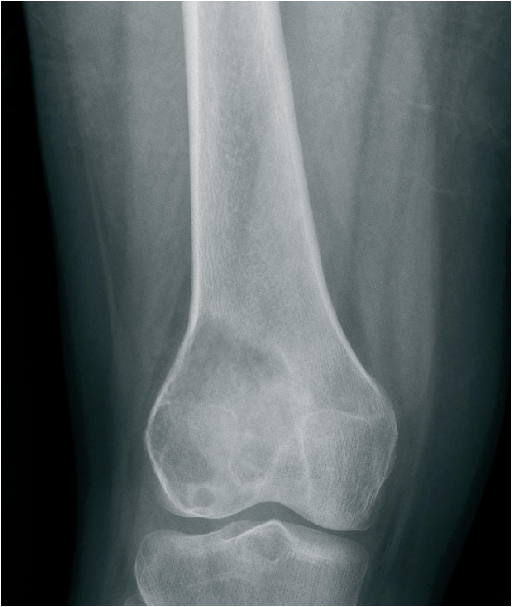 Fig. 20.1, Plain radiograph of a femoral tumor showing a well-defined, eccentric, lytic mass involving the distal metaphysis and epiphysis, extending to the subchondral plate.