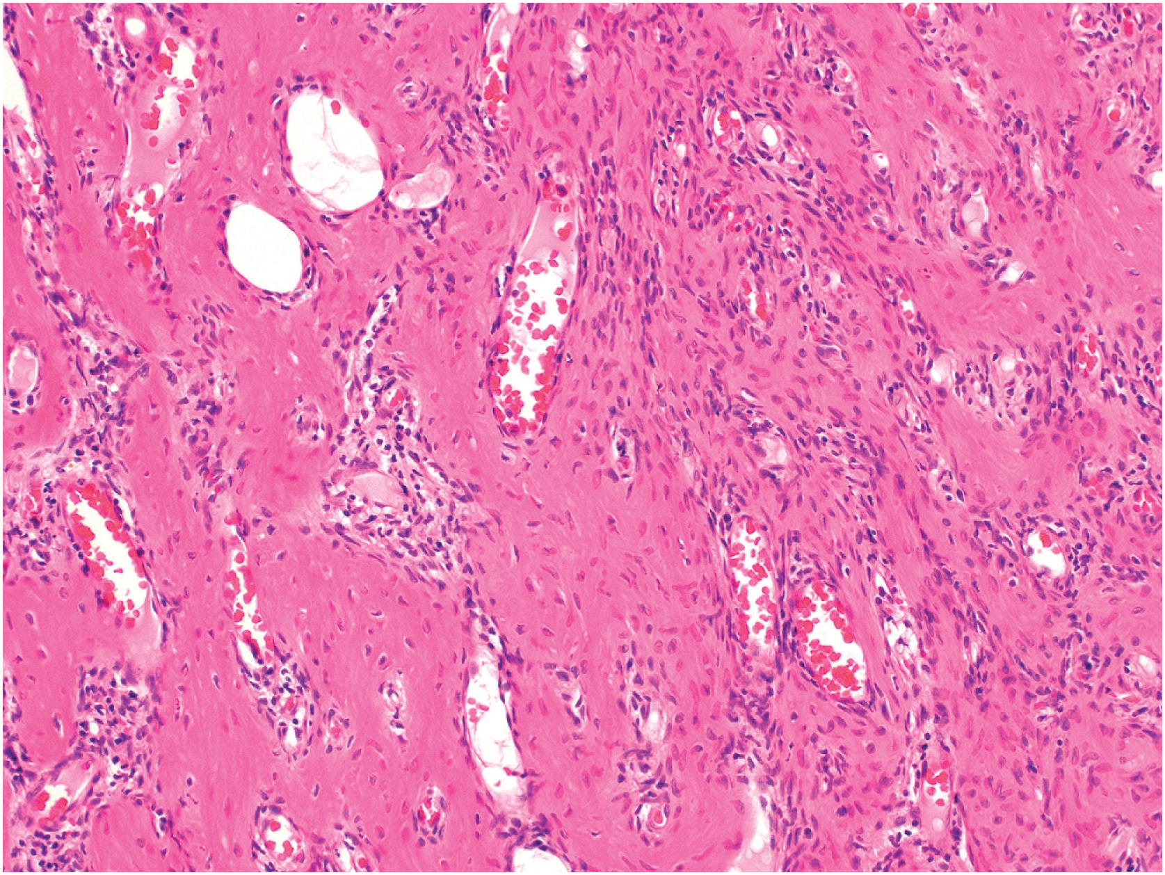 Fig. 20.11, Giant cell tumor after denosumab therapy showing fascicles of non-atypical spindle cells admixed with regularly distributed trabecular bone formation. Osteoclast-like giant cells are not seen.