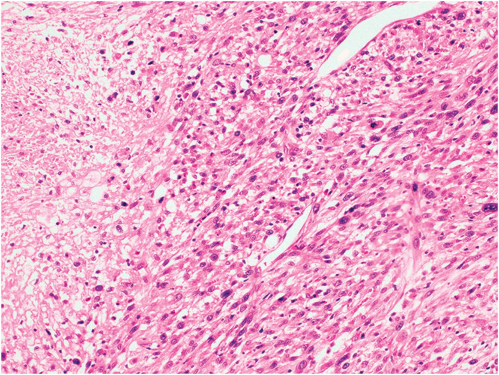 Fig. 20.12, Malignant giant cell tumor in the form of undifferentiated pleomorphic spindle cell sarcoma. This tumor arose at the site where conventional giant cell tumor of bone was curetted >10 years previously.