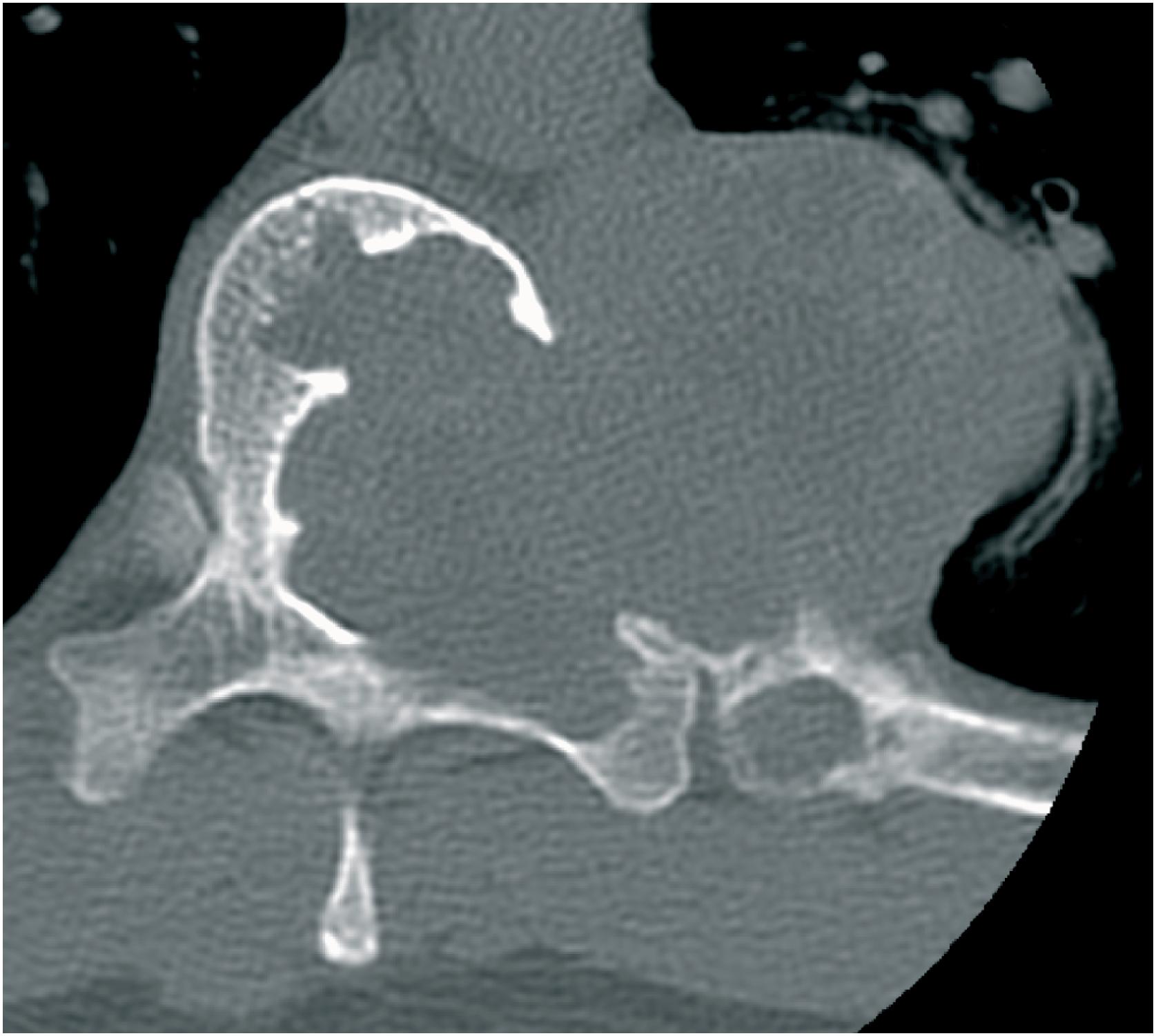 Fig. 20.2, An axial computed tomography (CT) of a tumor arising from the vertebral body and extending into the posterior elements showing a large well- demarcated lytic mass with cortical destruction and soft tissue extension.