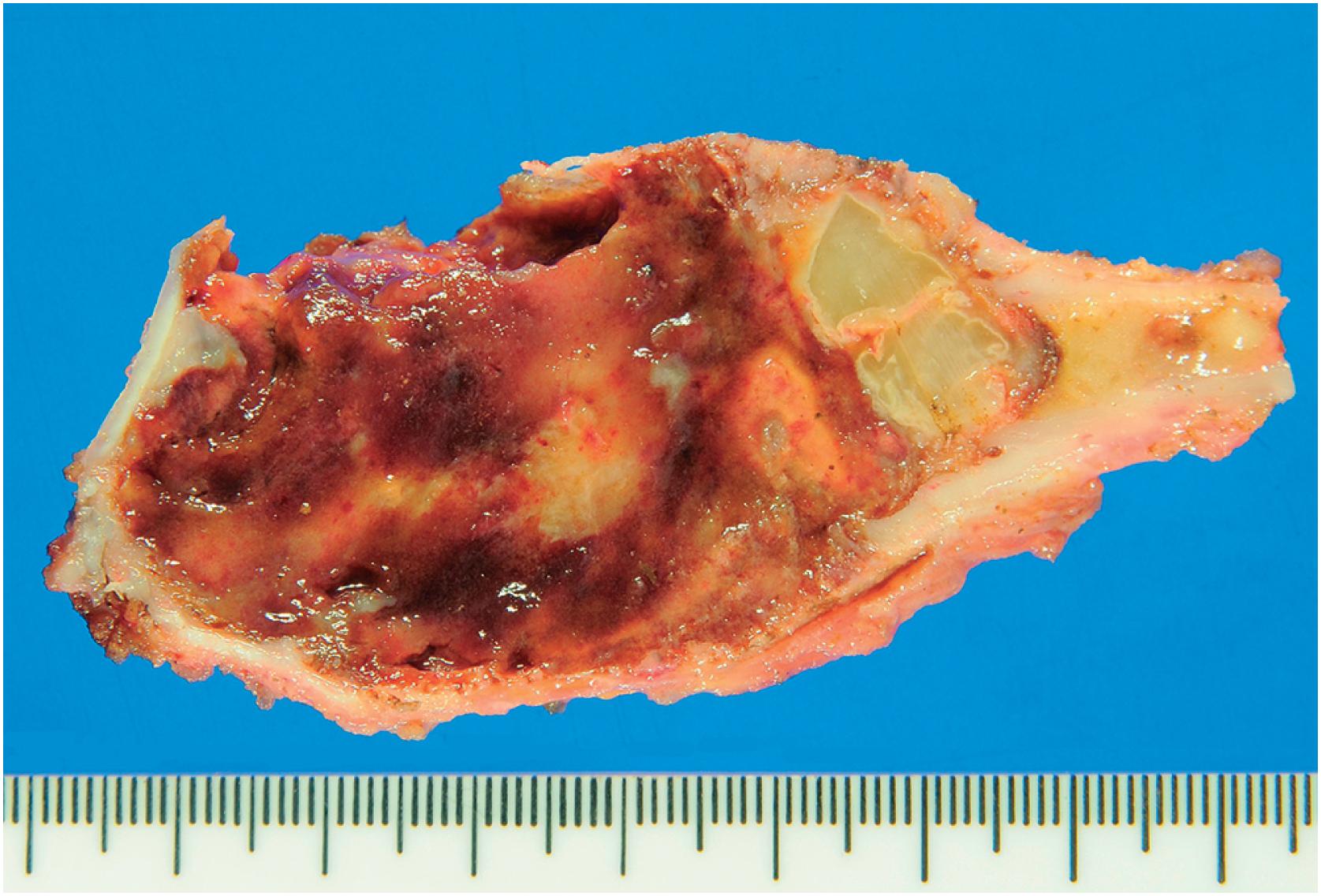 Fig. 20.3, A resected tumor arising in the fibular head showing a well-demarcated red-brown tumor that has expanded and destroyed the cortex.