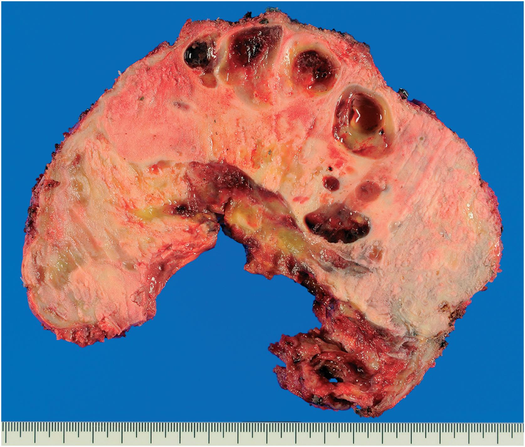 Fig. 20.4, A pelvic bone resected after denosumab therapy showing a white calcified tumor with cystic changes.