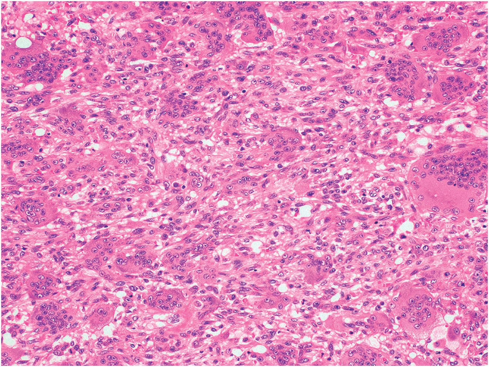 Fig. 20.5, Classic histology showing sheets of mononuclear cells admixed with evenly distributed large osteoclast-like giant cells.