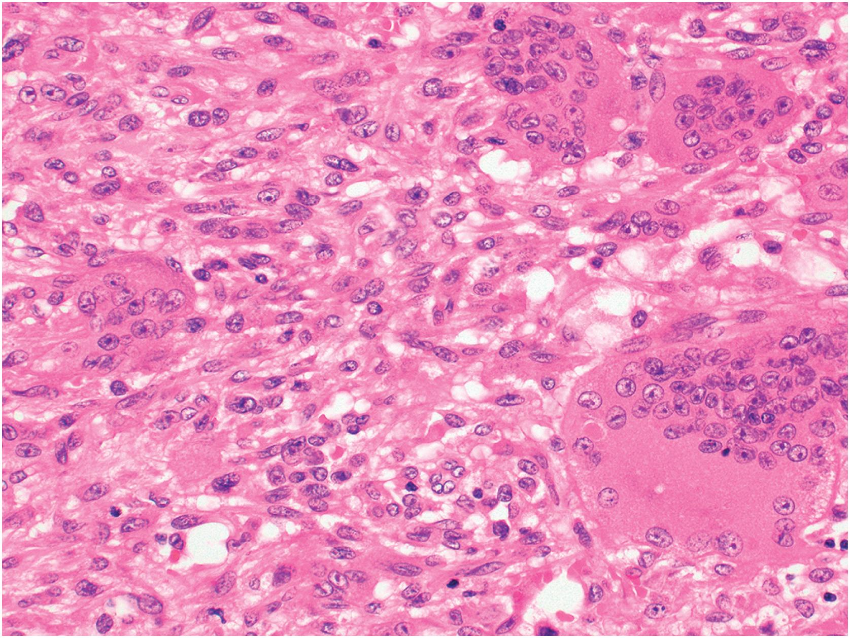 Fig. 20.6, High-power view showing bland oval to spindle-shaped mononuclear cells.