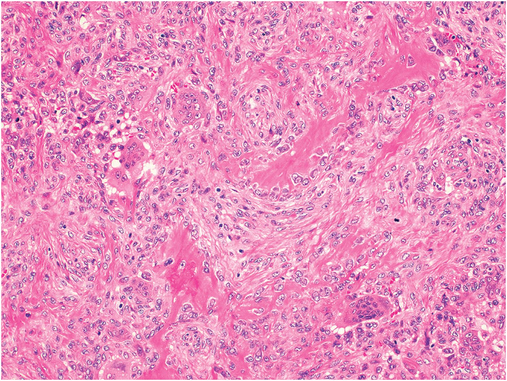 Fig. 20.7, Bone formation in giant cell tumors is usually reactive and trabecular in appearance.