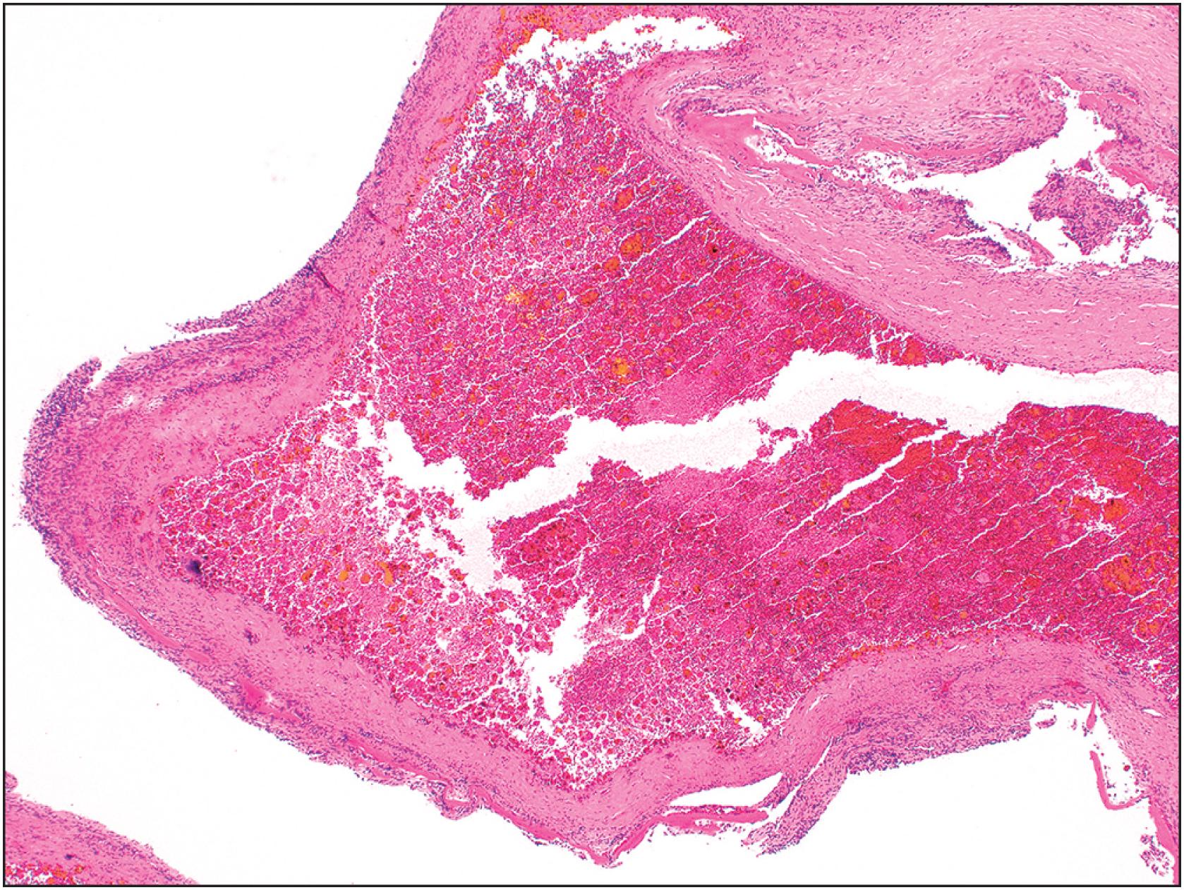 Fig. 20.9, Aneurysmal bone cyst-like secondary change.