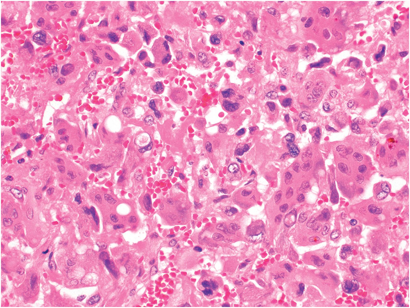 Fig. 20.10, Rare tumors show degenerative nuclear atypia, including lobulation, smudgy chromatin, and intranuclear pseudoinclusion.