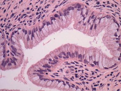 Figure 9-1, Typical endocervical canal epithelium. This simple epithelium shows uniform nuclei located in the basal portion of the cells and mucus-filled granular apical cytoplasm. This appearance is most characteristic of the endocervical epithelium directly adjacent to the transformation zone (H&E, ×HP).