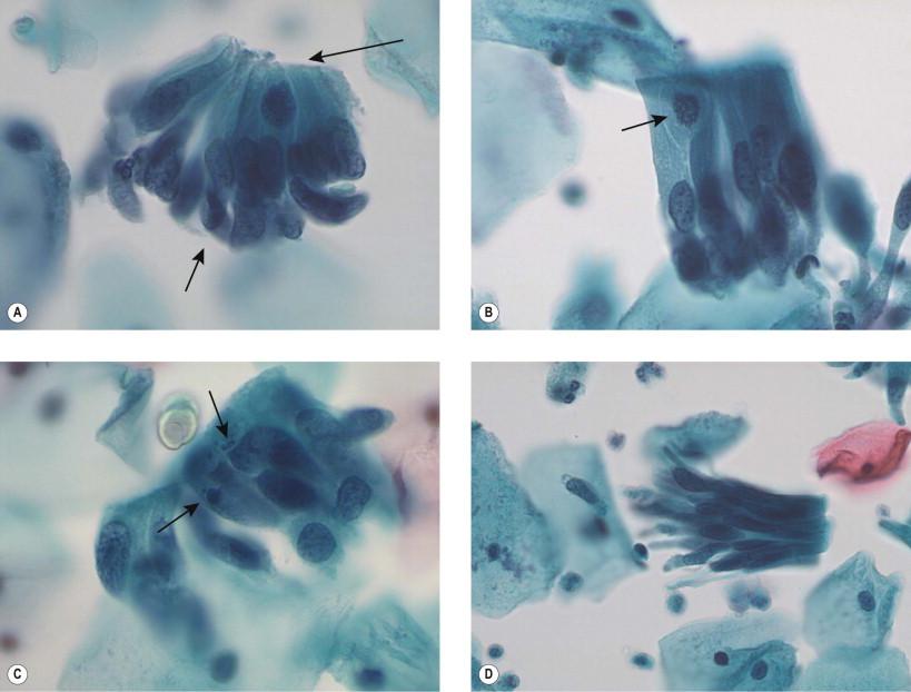 Figure 9-12, Four examples of pseudostratified groups of cells. In (A), the luminar surface is shown with a long arrow, and the basal portion of the epithelium is shown with a short arrow. In (B), a mitotic figure is noted (arrow), and in (C), apoptotic nuclear debris is present (arrows); (D) shows a typical “bird tail” arrangement with splayed (feathered) border (liquid-based preparation, Papanicolaou, ×HP).