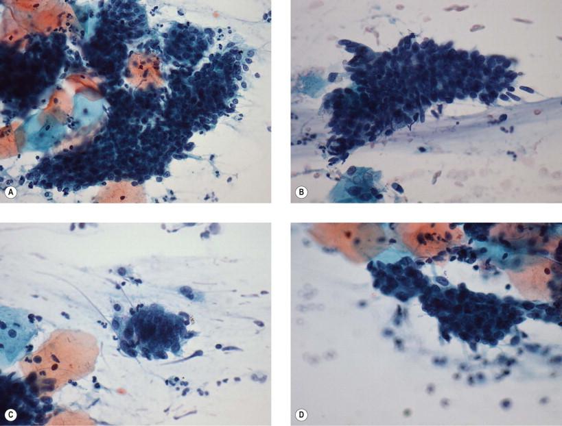 Figure 9-13, The endometrioid (or “small cell”) variant of endocervical AIS. (A) A hyperchromatic crowded grouping of very densely packed small cells resembling endometrium. In (B), feathering is noted at the margins of the group and can be a clue to the correct interpretation. (C) A pseudostratified strip of cells can be seen. Compared with similar architectural strips seen in Fig. 9-12 , these cells are much smaller. (D) A smooth contoured group of endometrioid AIS (conventional smear, Papanicolaou, ×HP).